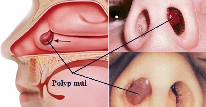 phẫu thuật polyp mũi