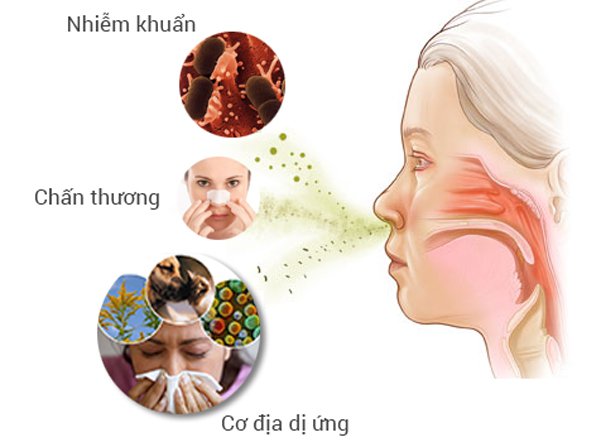 Viêm mũi dị ứng ở trẻ em
