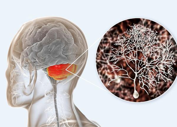 Triệu chứng thoái hóa tiểu não