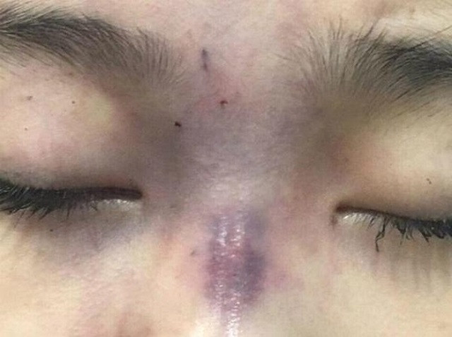 Tiêm filler biến chứng nguy hiểm