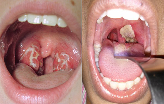 Vi khuẩn bạch hầu dưới kính hiển vi