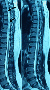 Hình ảnh MRI rỗng tủy sống