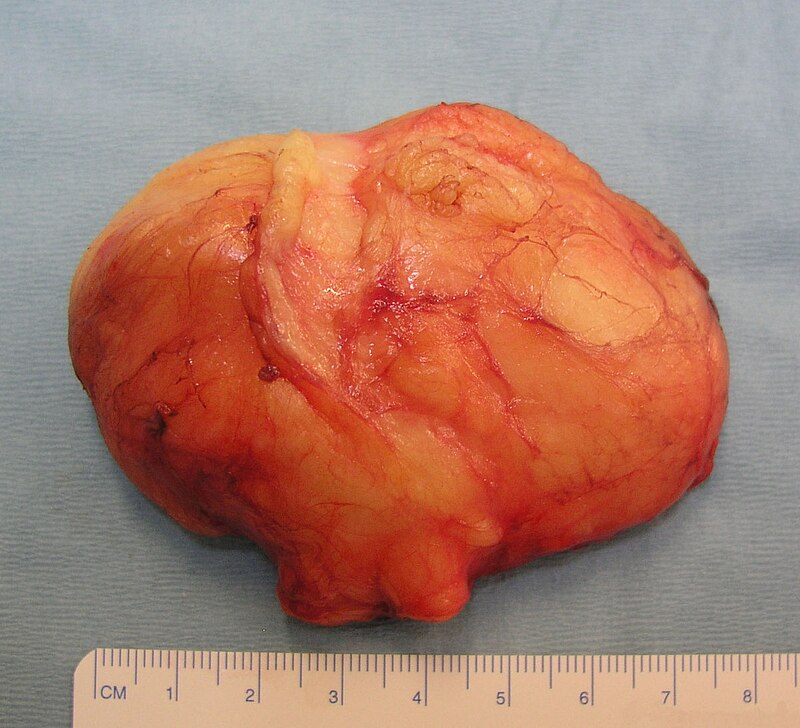 So sánh với Lipoma