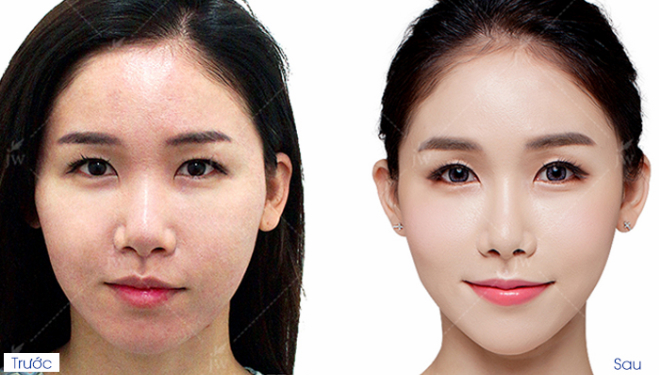 kết quả cấy mỡ tự thân lên mặt