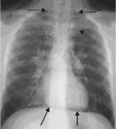 CT Scan khí trung thất