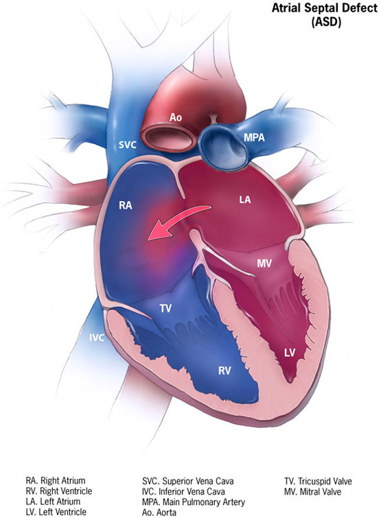 Hình ảnh mô phỏng thông liên nhĩ (ASD)