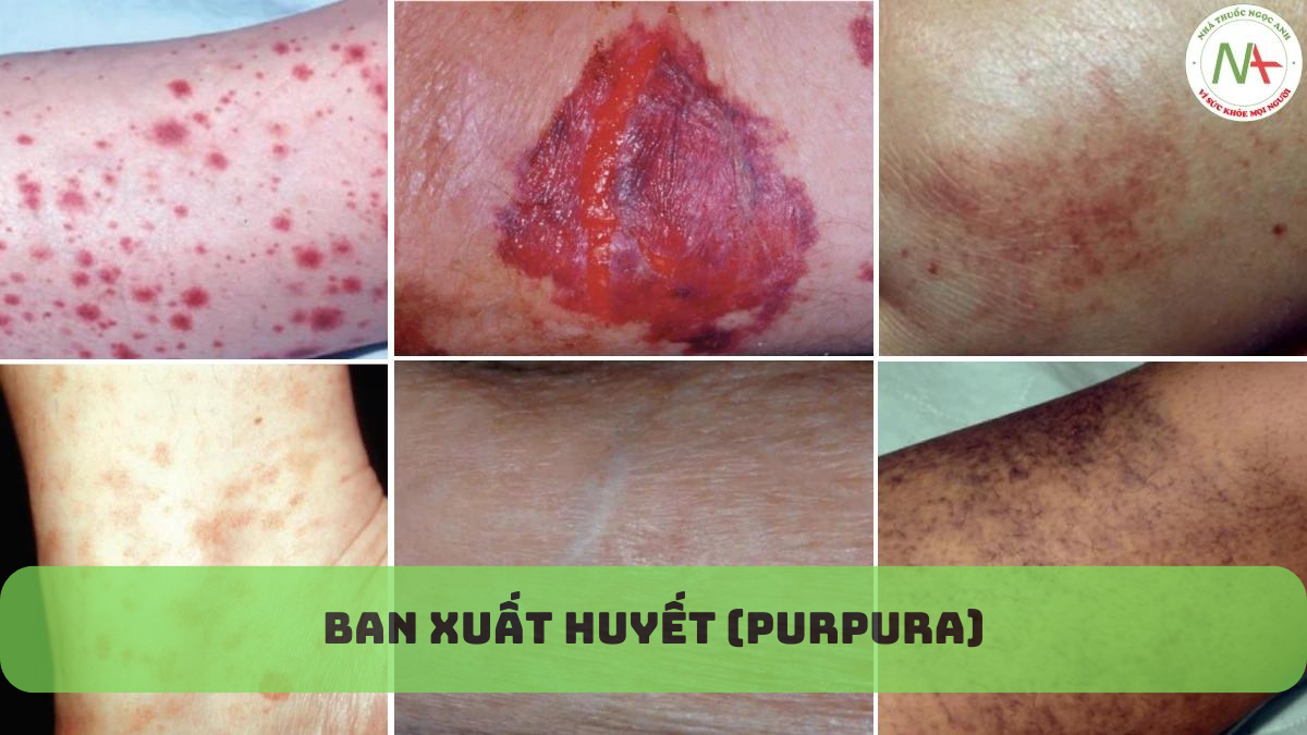 Ban xuất huyết dạng sờ thấy