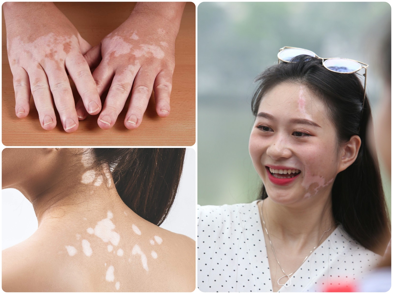 Bạch biến ảnh hưởng thẩm mỹ và tâm lý người bệnh