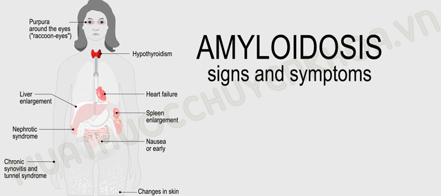 Hình ảnh minh họa amyloidosis phổi