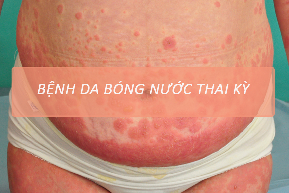 Bóng nước vùng bụng do pemphigoid thai kỳ