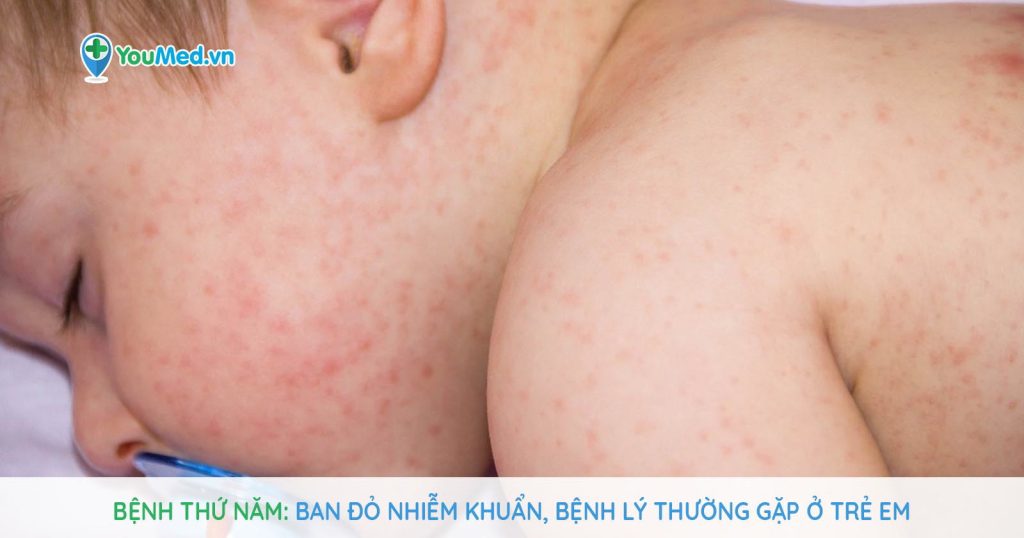 sốt phát ban ở trẻ sơ sinh