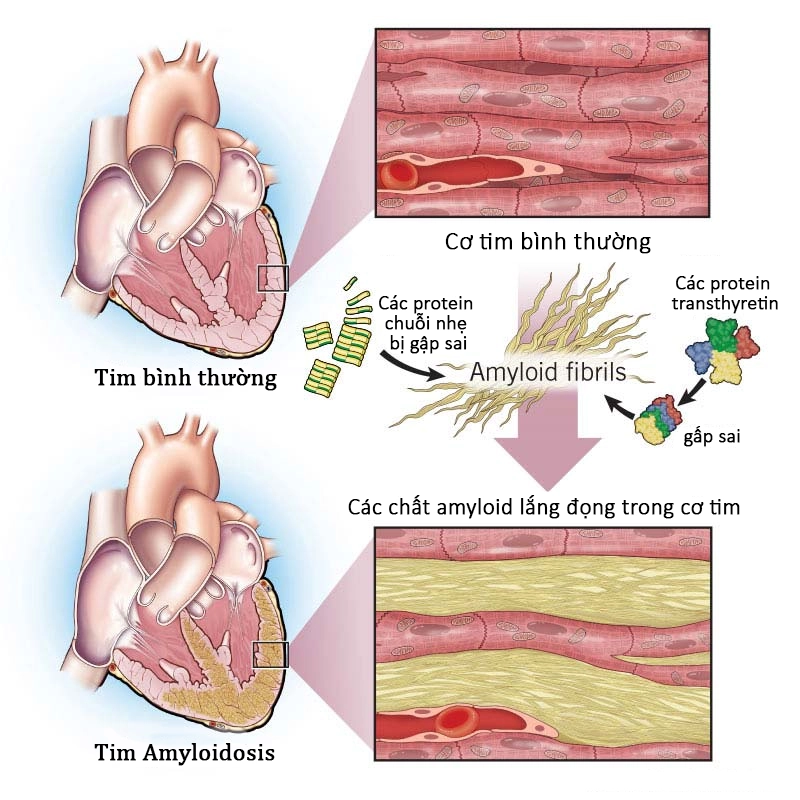 Protein amyloid tích tụ trong tim