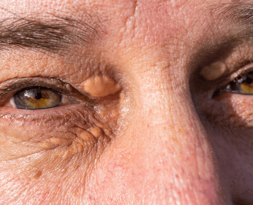 xanthelasma mí mắt