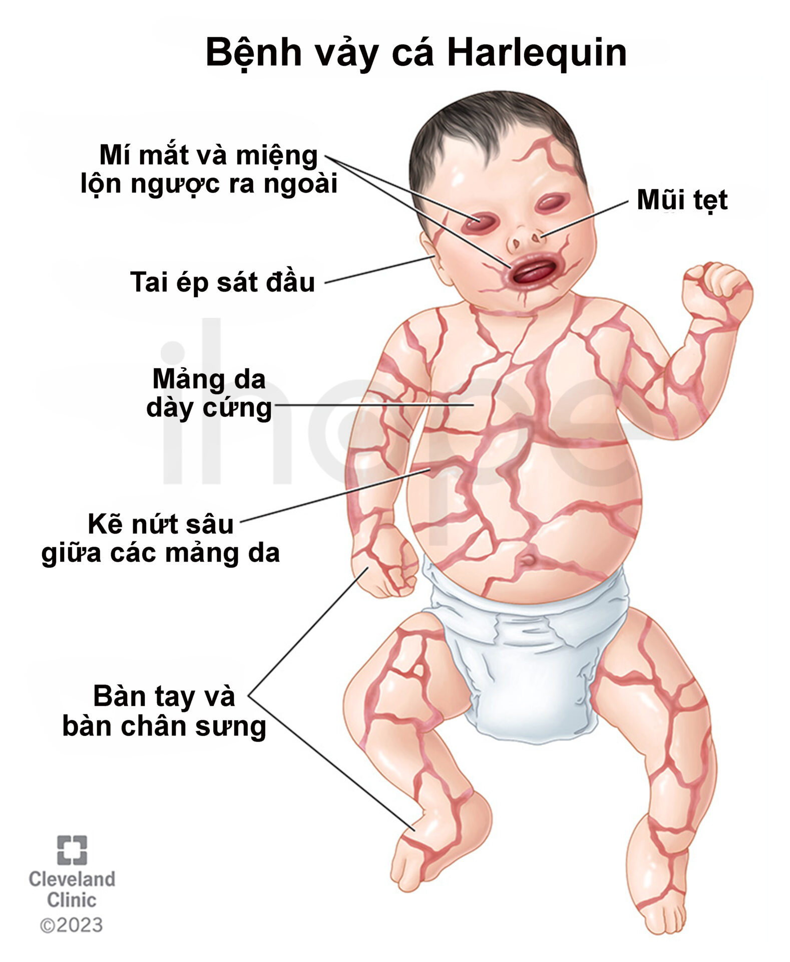 Bé gái mắc bệnh vảy cá Harlequin