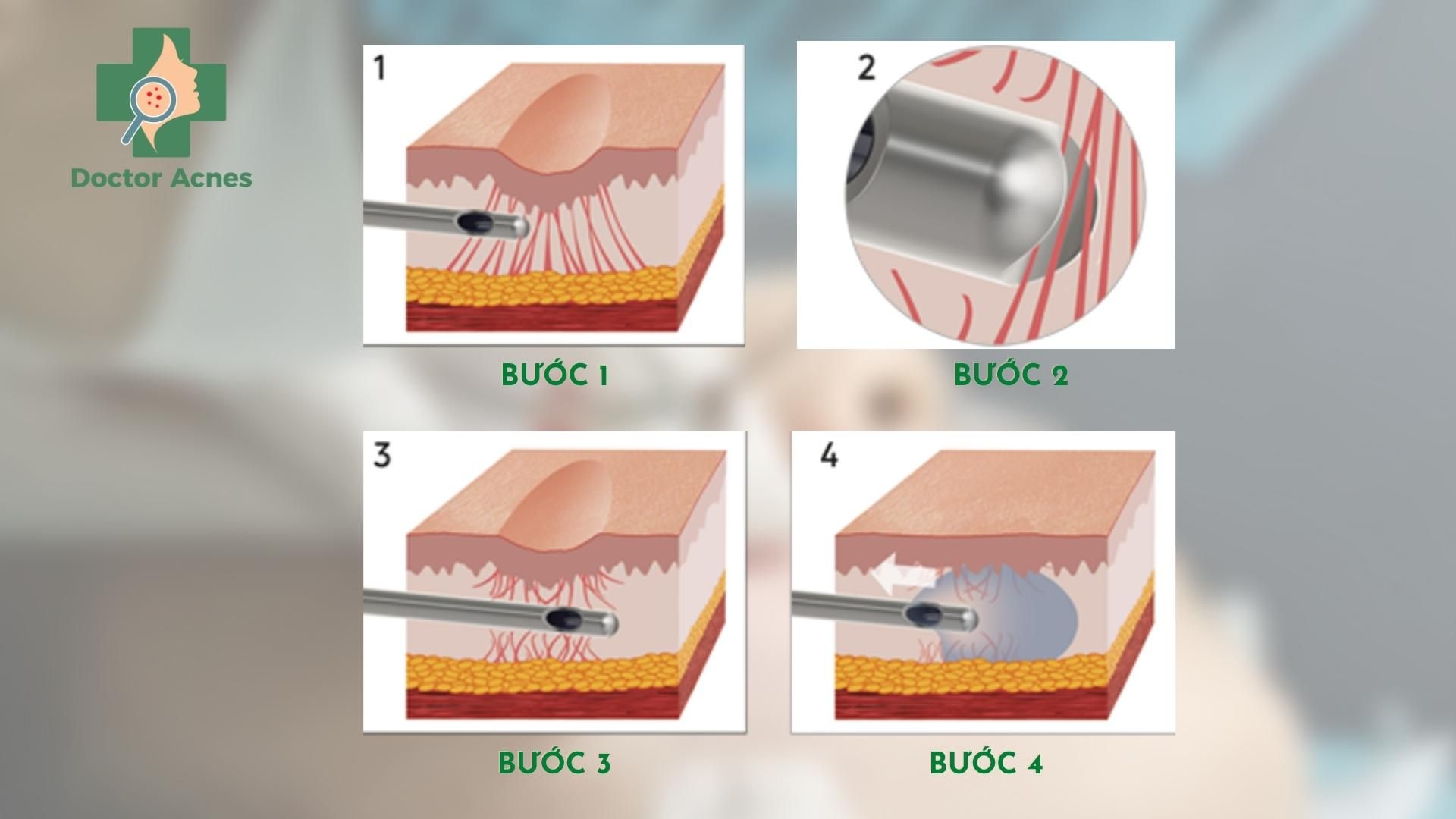 Tách sẹo rỗ (bóc tách đáy sẹo): Bước quan trọng trong điều trị sẹo 7 Tách đáy sẹo bằng cannula