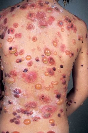pemphigoid kết mạc mắt