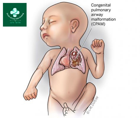 Siêu âm thai phát hiện dị dạng phổi