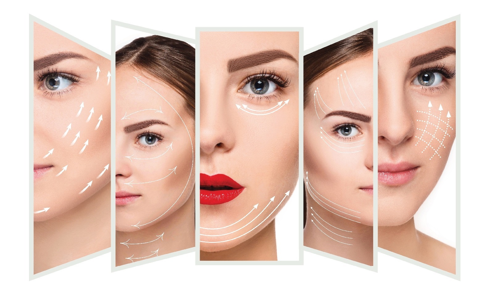 Các loại chỉ thẩm mỹ phổ biến