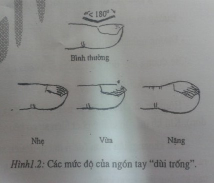 Các mức độ ngón tay dùi trống