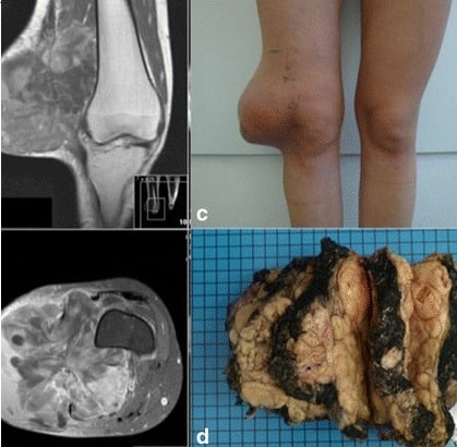 Sarcoma màng hoạt dịch: Triệu chứng, chẩn đoán và điều trị hiệu quả 7 Hình ảnh lâm sàng và X-quang của bệnh nhân bị sarcoma màng hoạt dịch