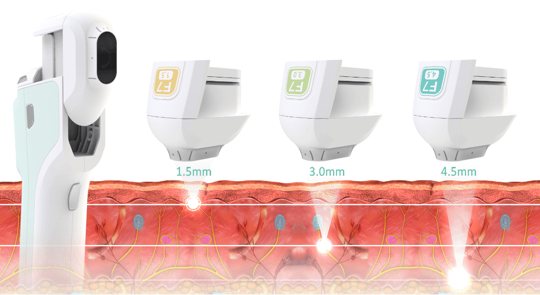 Cơ chế hoạt động của HIFU