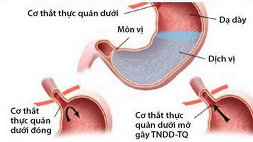 Co thắt cơ thực quản: Nguyên nhân, Triệu chứng và Cách điều trị 7 Hình ảnh co thắt cơ thực quản