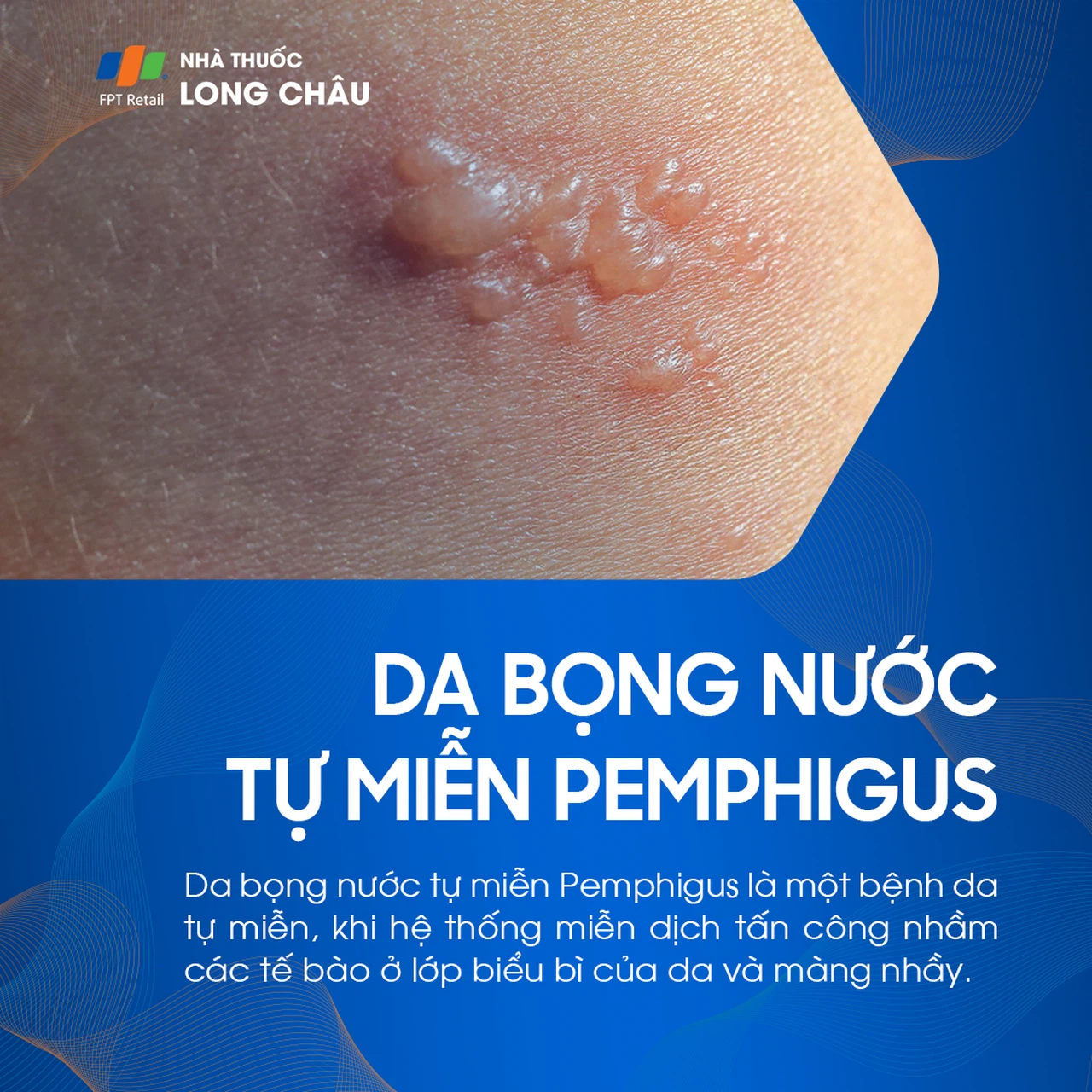 pemphigoid màng nhầy miệng