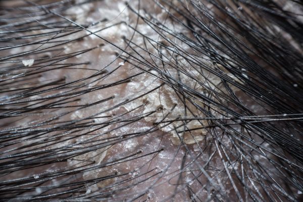 Dầu gội trị nấm da đầu phổ biến