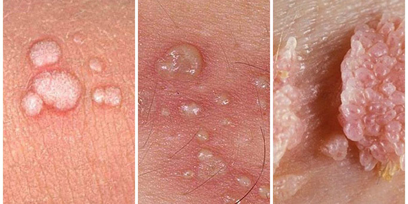 Dấu hiệu điển hình của nhiễm HPV: mụn cóc sinh dục