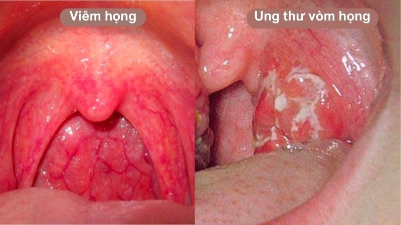 Cấu trúc vòm họng - ung thư vòm họng