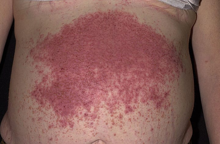 Viêm da dạng Herpes (Dermatitis Herpetiformis): Triệu chứng, nguyên nhân và điều trị 8 Tổn thương da do viêm da dạng Herpes