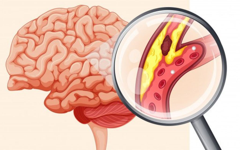 Đột quỵ do thuyên tắc từ tim