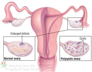 Dự trữ buồng trứng suy giảm