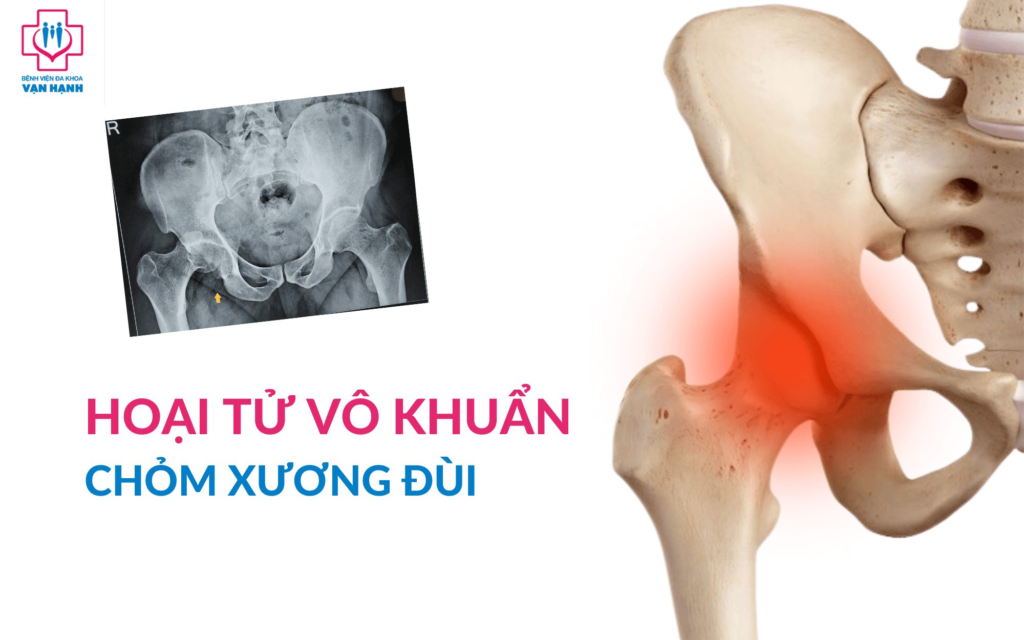Hoại tử vô khuẩn chỏm xương đùi