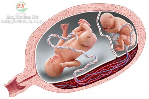 Điều trị hội chứng truyền máu song thai bằng Laser