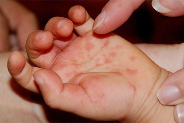 mụn nước tay chân miệng ở trẻ