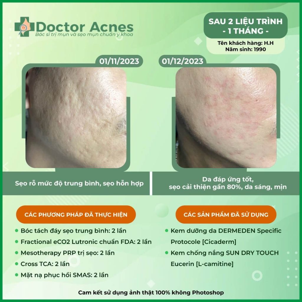 hieu-qua-laser-co2-fractional.jpg