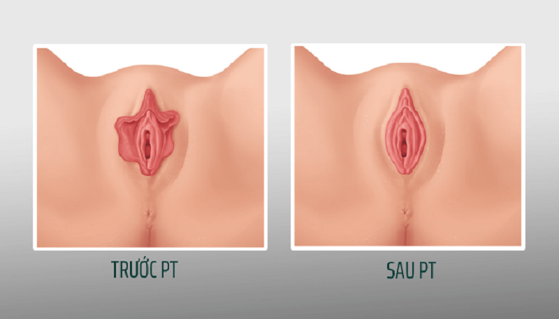 Hình ảnh trước và sau thu nhỏ môi bé