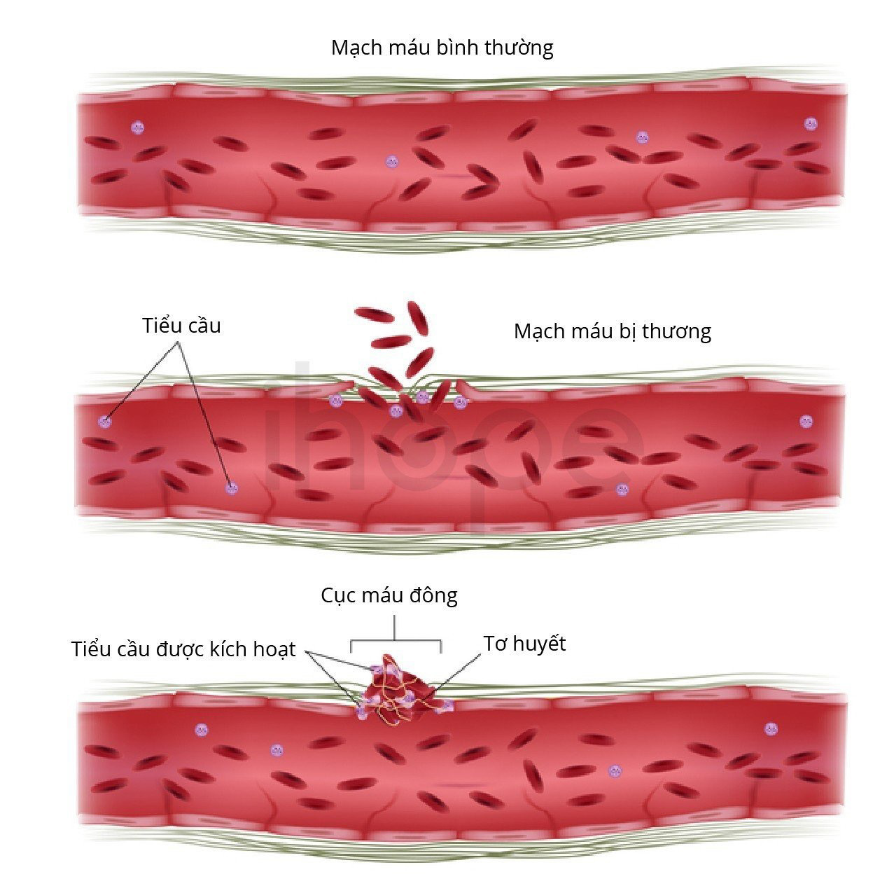 Sinh thiết tủy xương