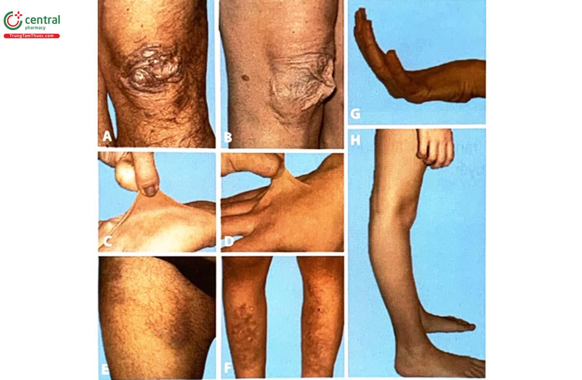 Hình ảnh mô liên kết bị suy yếu do đột biến COL3A1