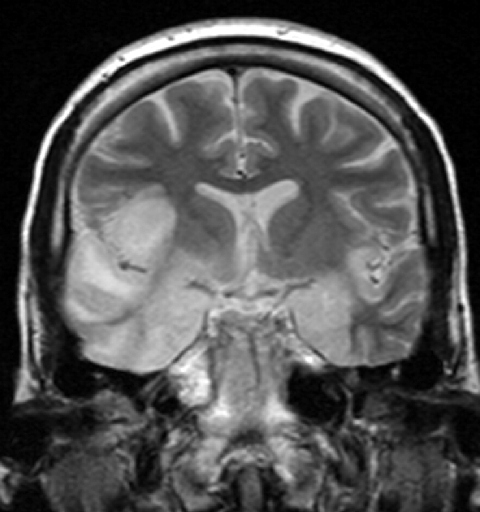 Virus HSV gây viêm não
