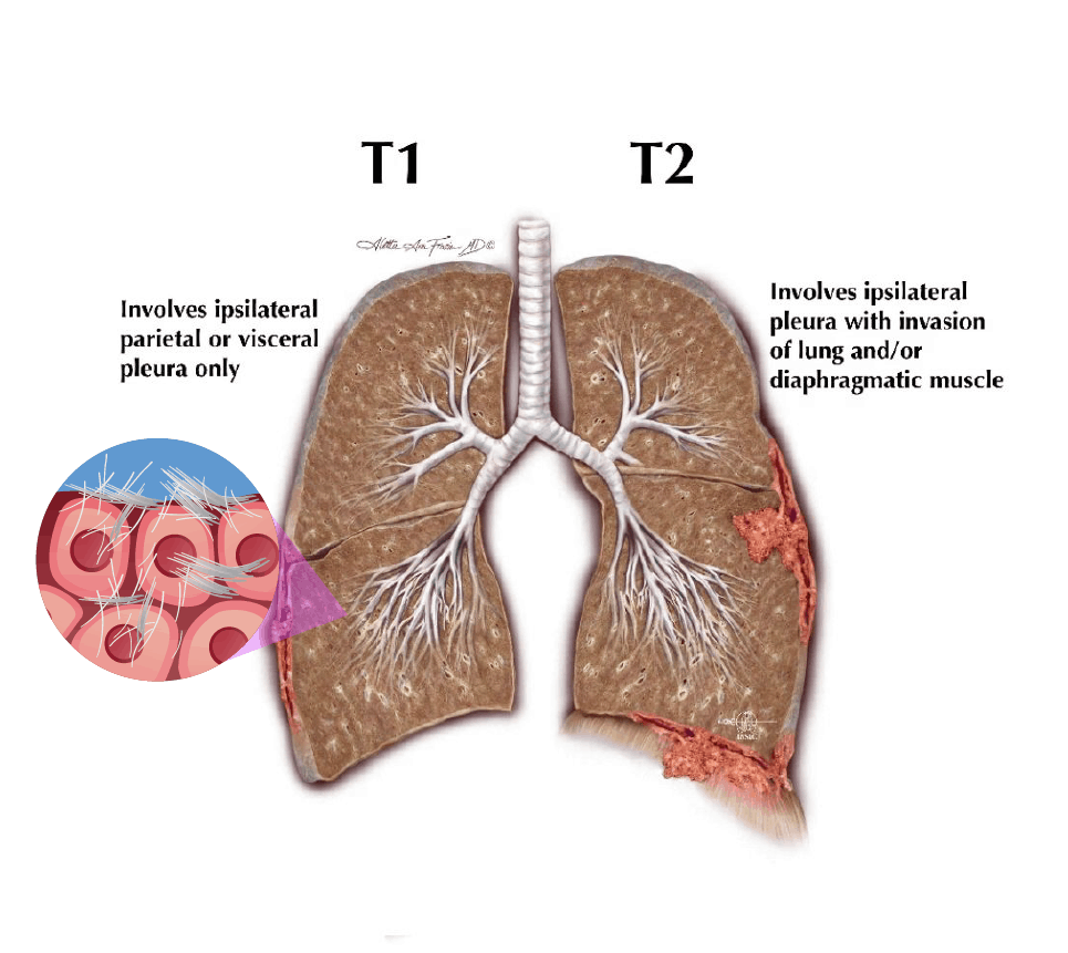 các giai đoạn mesothelioma