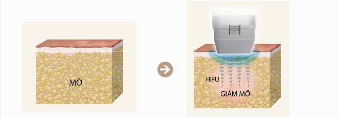 Quy trình điều trị bằng LIPOcel Quy trình điều trị bằng LIPOcel