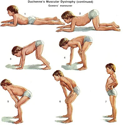 Loạn dưỡng cơ Duchenne ở trẻ em