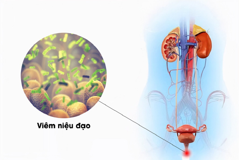 Nhiễm Trùng Đường Tiết Niệu Tái Phát: Nguyên Nhân, Triệu Chứng và Cách Điều Trị Hiệu Quả 8 triệu chứng tiểu buốt tiểu rắt