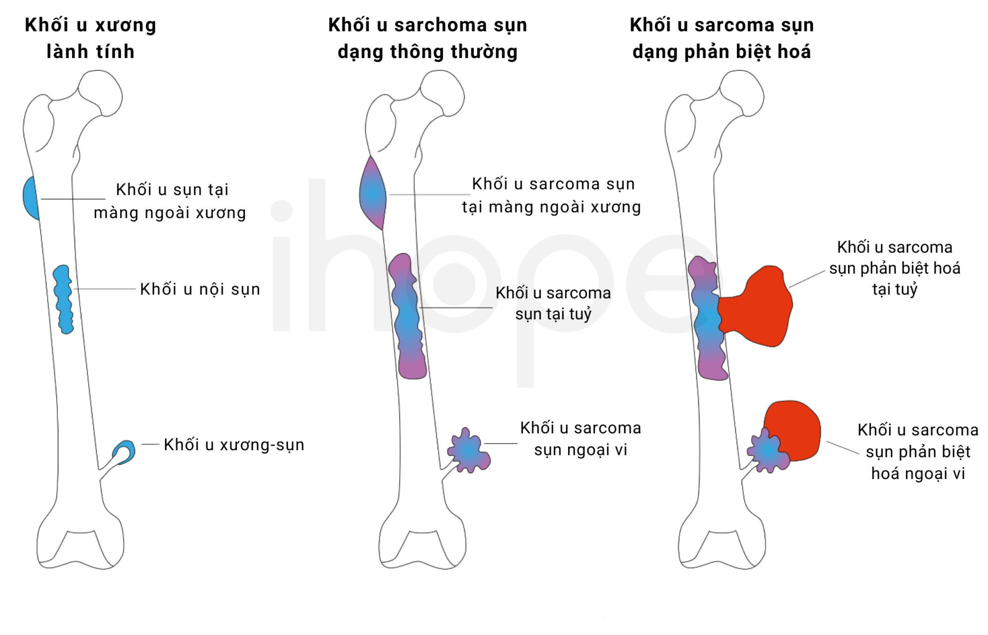 Các loại sarcoma sụn phổ biến