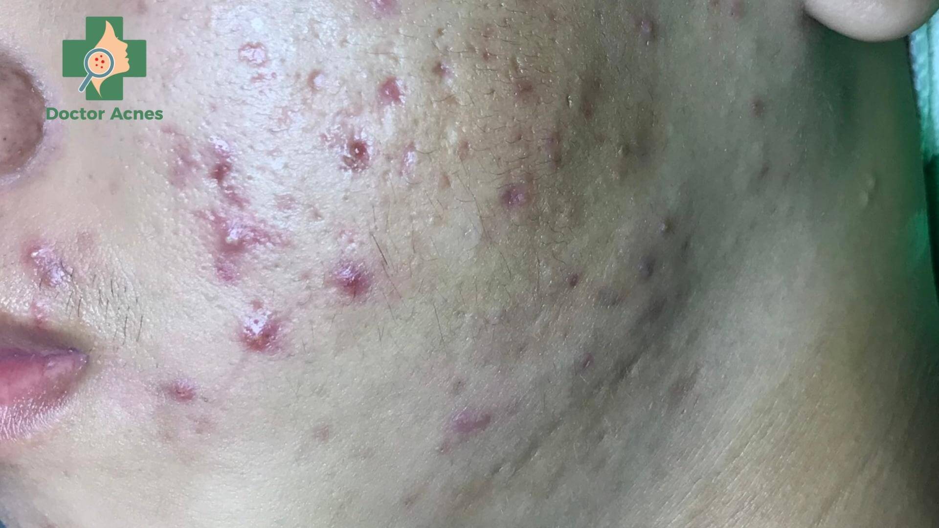 Mụn trứng cá nặng điều trị bằng Isotretinoin