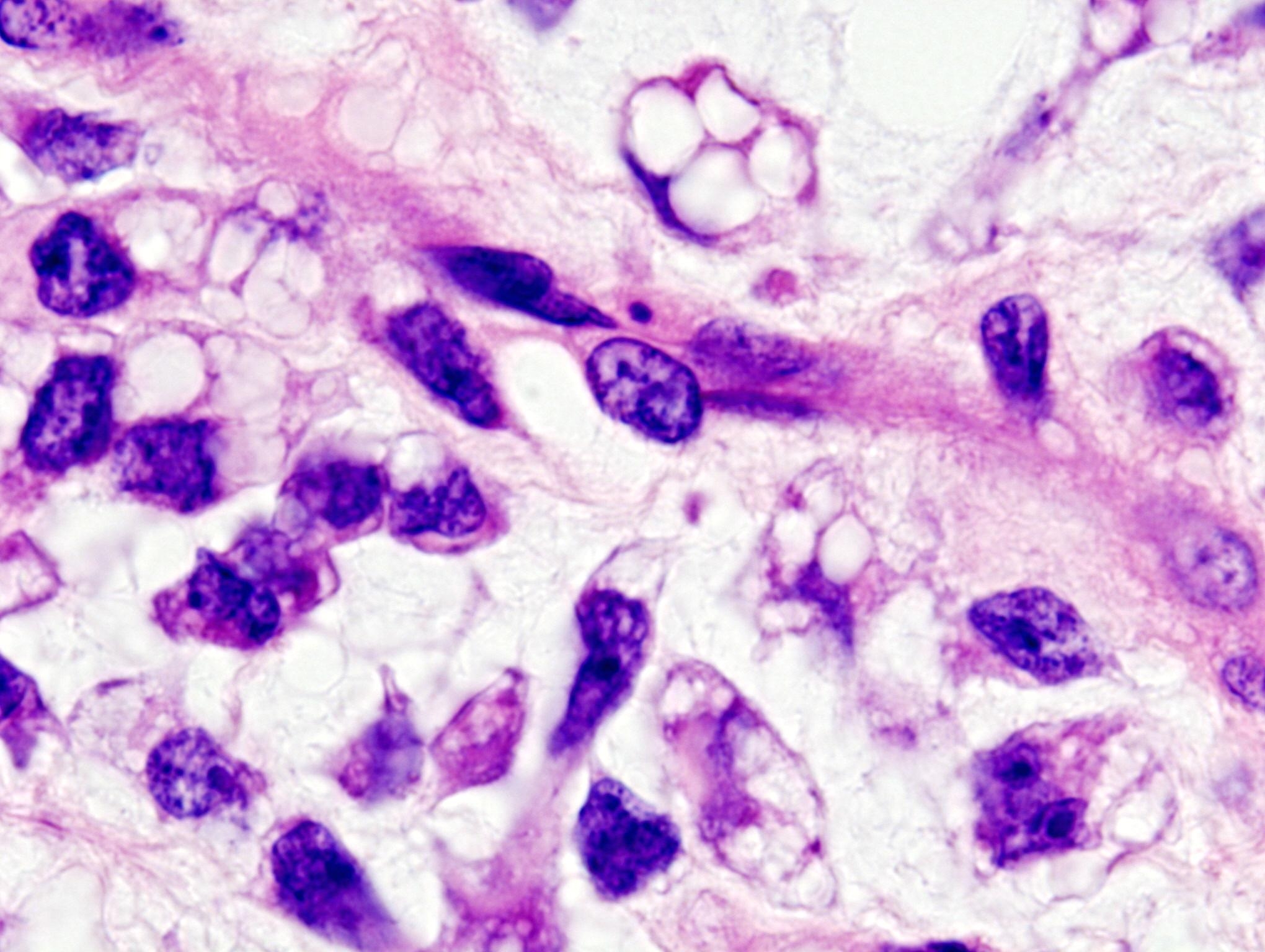 Hình ảnh mô học sarcoma cơ vân