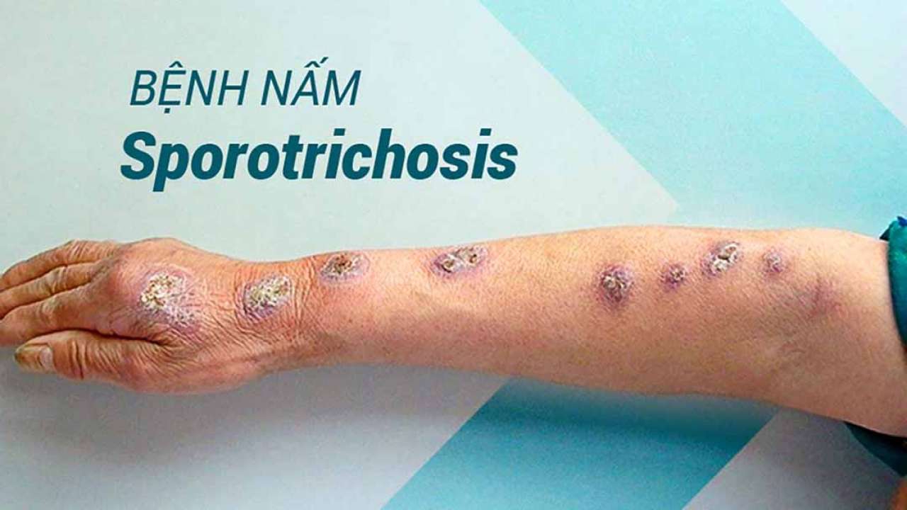 Nấm sâu Sporothrix là gì