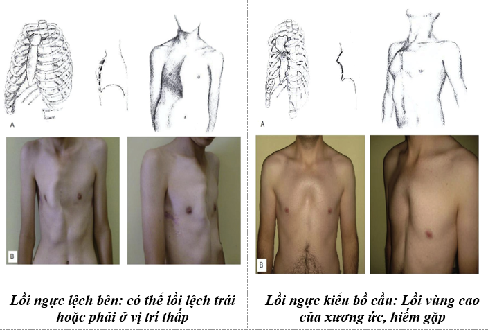 Dị tật ngực ức gà ở trẻ